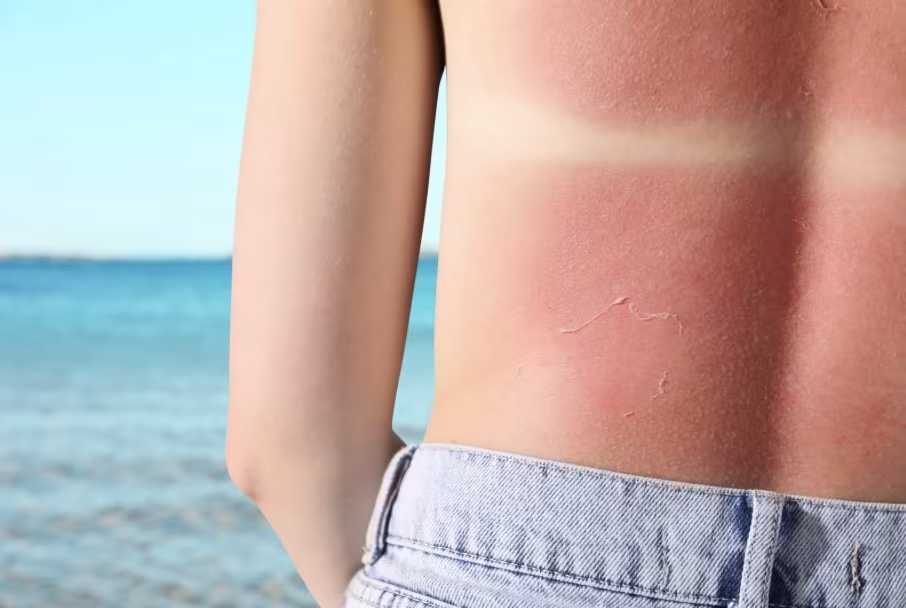 What to Do If You Get Caught Out with Sunburn